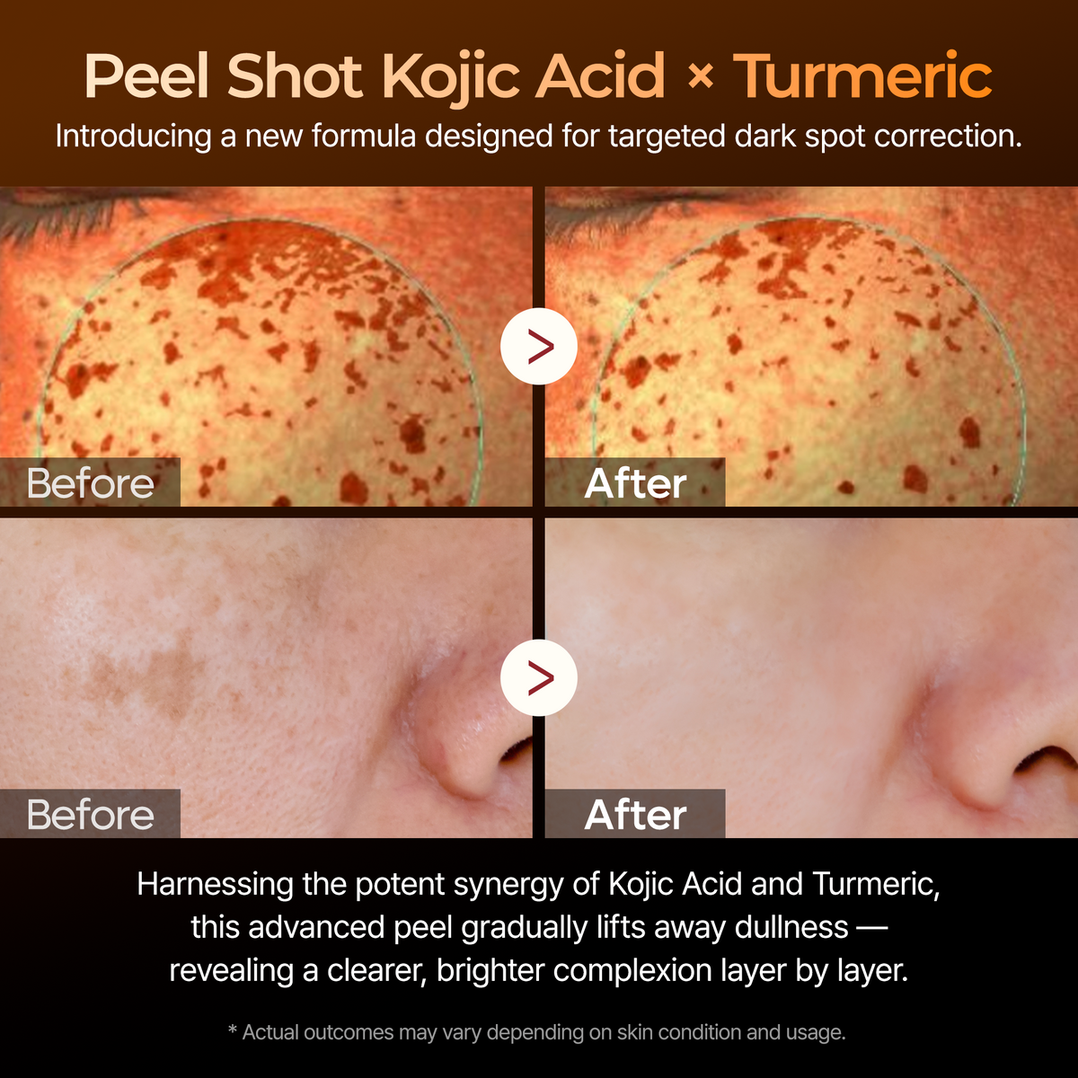 Peel Shot Kojic Acid Turmeric Serum - Dr.Melaxin.us