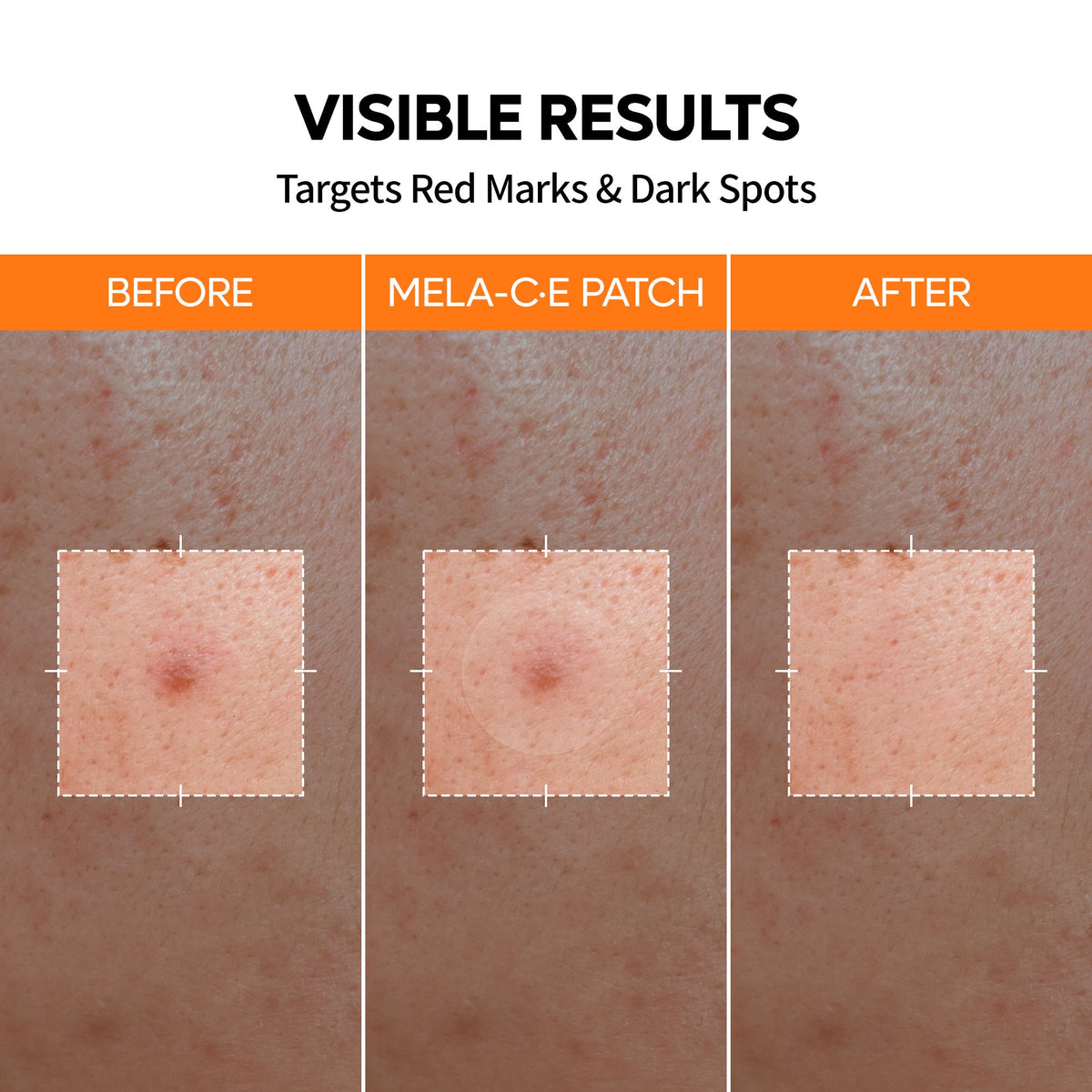 Zero Fit Blemish & Dark Spot Patch Duo - Dr.Melaxin.us
