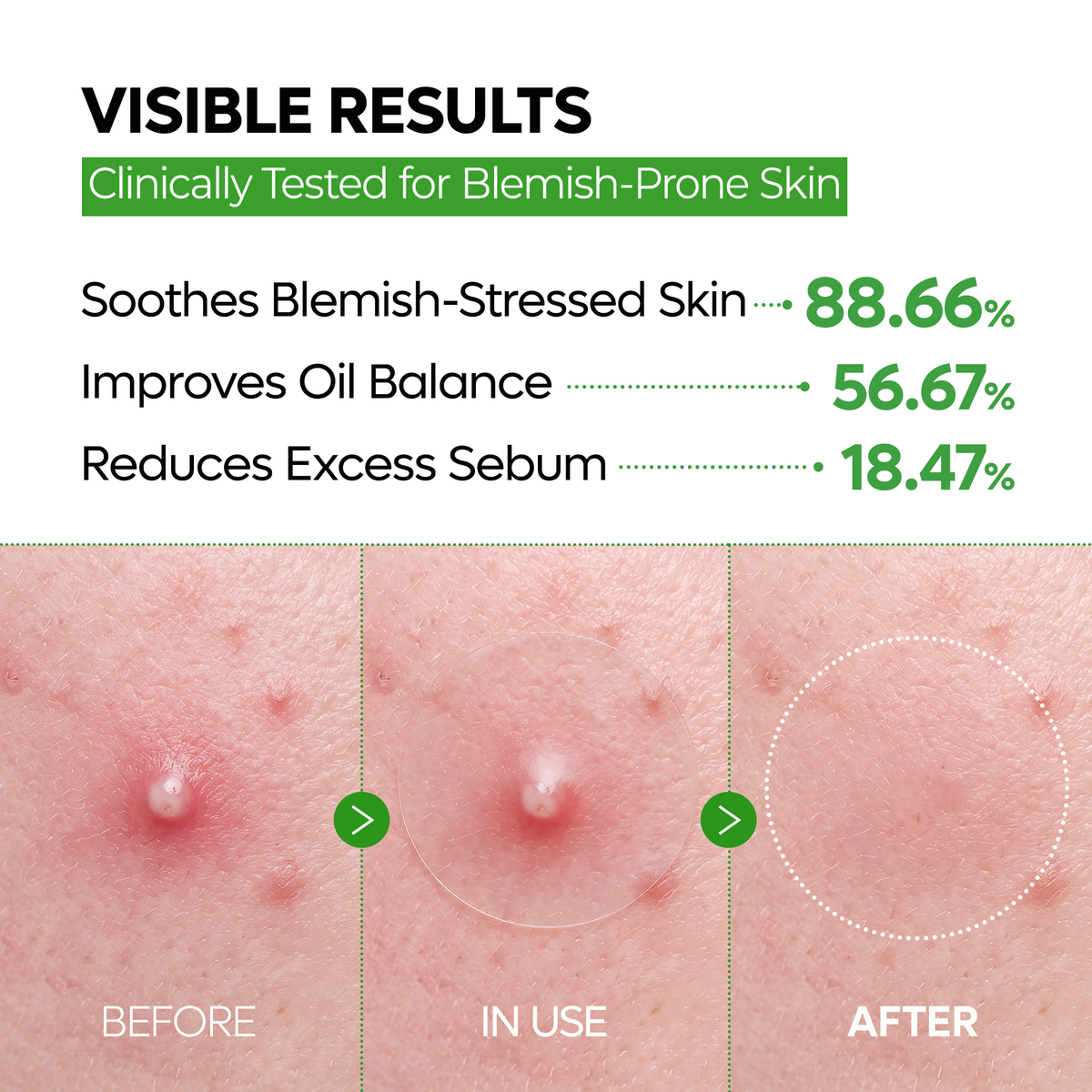 S-ZINC ZERO FIT Ultra Thin Blemish Spot Patch - Dr.Melaxin.us